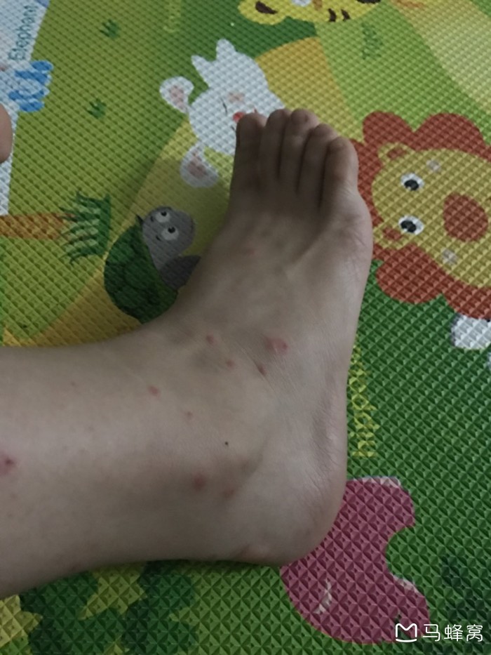 在三亚海边被一种小黑虫子咬了,奇痒无比,跪求解决办法