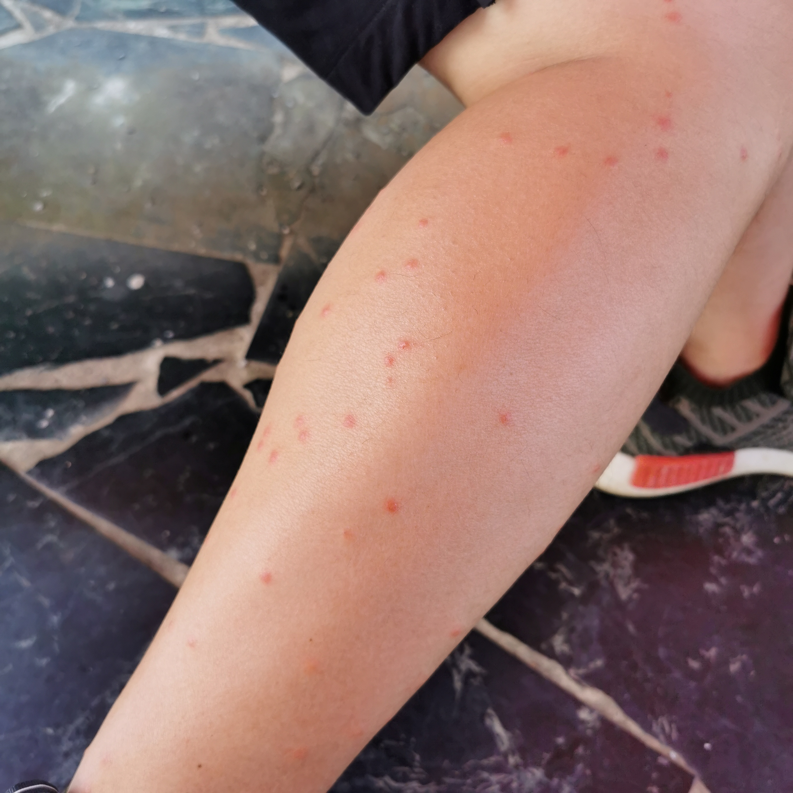 啦,跳骚诶,公腿被咬100包,跟员完