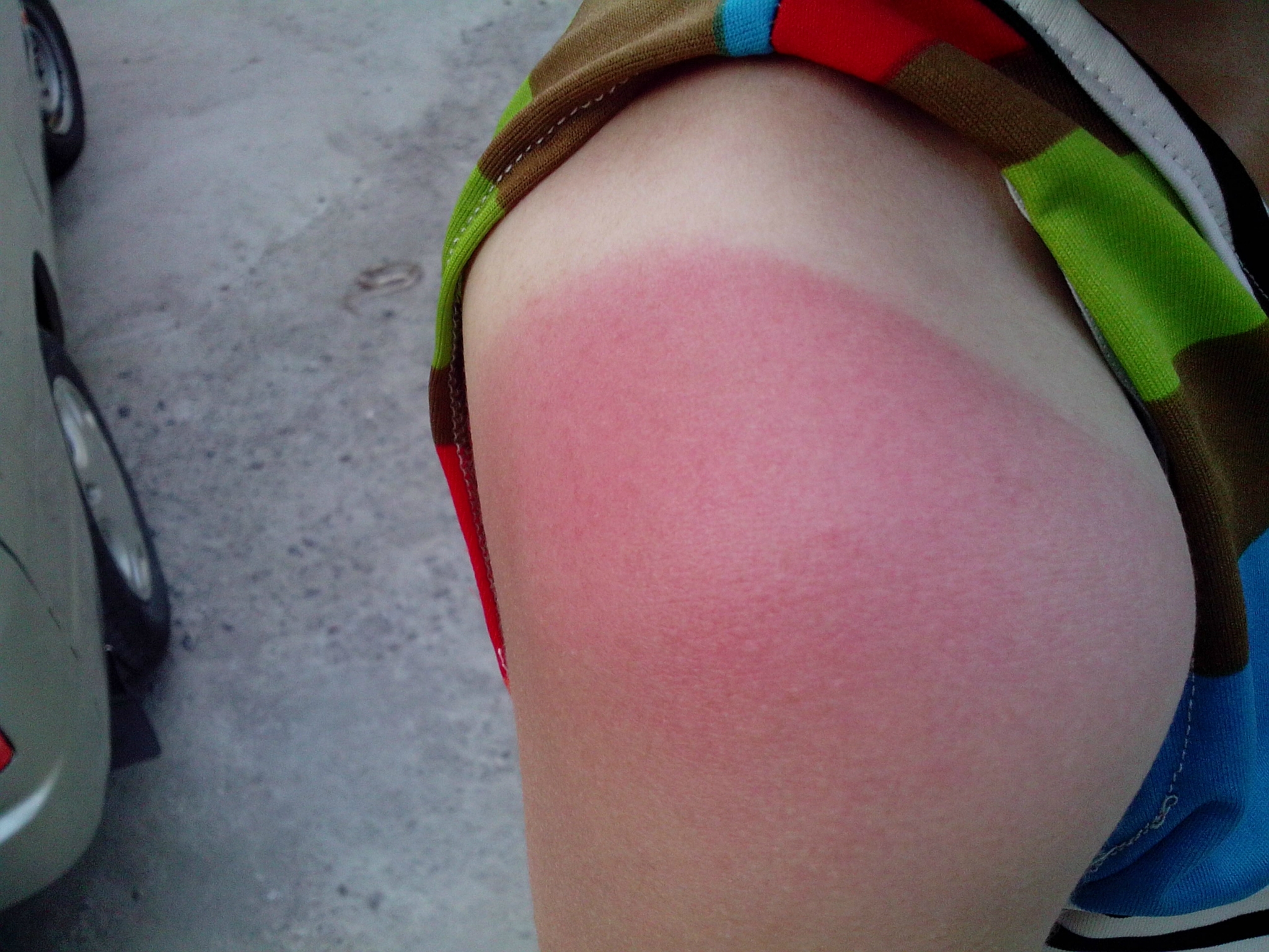 没有在隔壁上涂抹防晒霜,结果我的肩膀不到2个小时就被晒伤了,真是